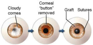 Cornea Transplant | Lee Eye Center